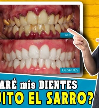 limpieza dental antes y despues