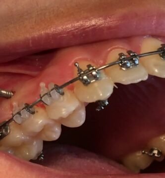 microtornillos ortodoncia