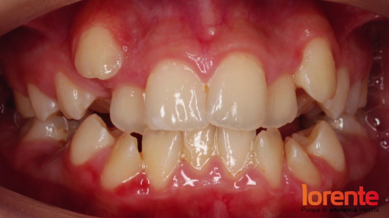 ortodoncia antes y despues