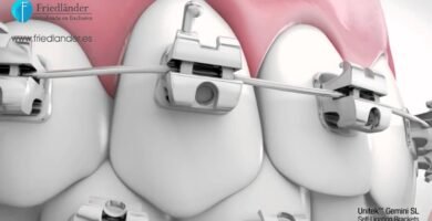 ortodoncia autoligado