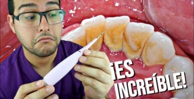 ¿Cómo me puedo quitar el sarro de los dientes?