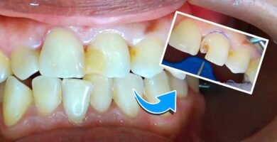 ¿Cómo se arreglan los dientes picados?