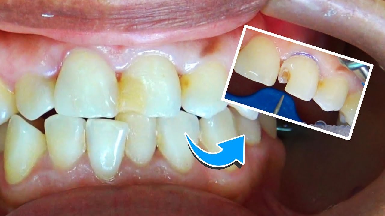¿Cómo se arreglan los dientes picados?