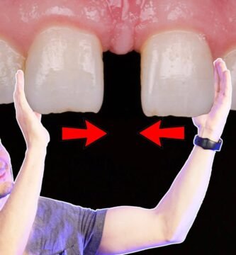 ¿Cómo se llama el tratamiento para rellenar los dientes?