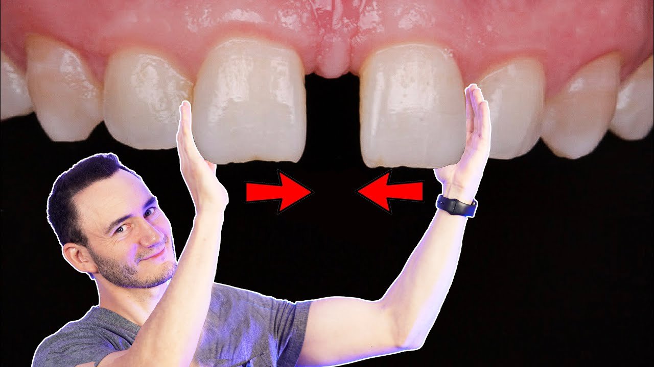 ¿Cómo se llama el tratamiento para rellenar los dientes?