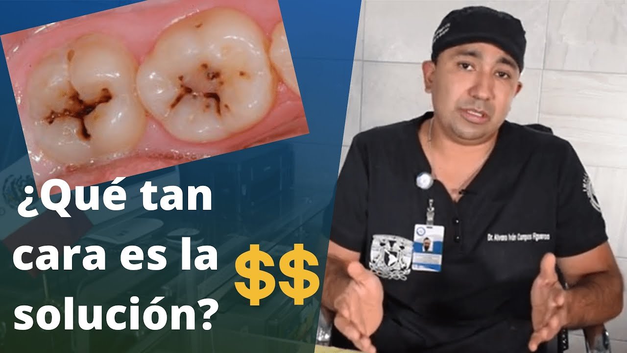 ¿Cuánto tiempo puede estar una carie sin tratar?
