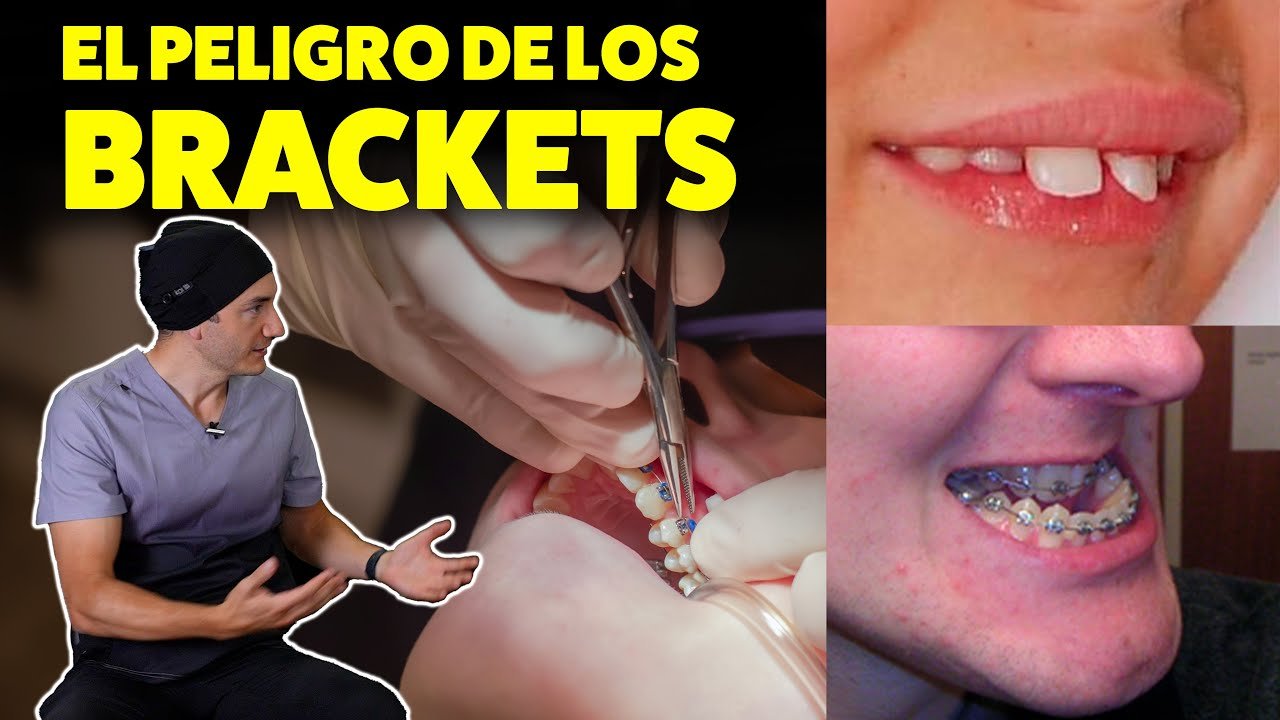 ¿Qué desventaja tiene los brackets?