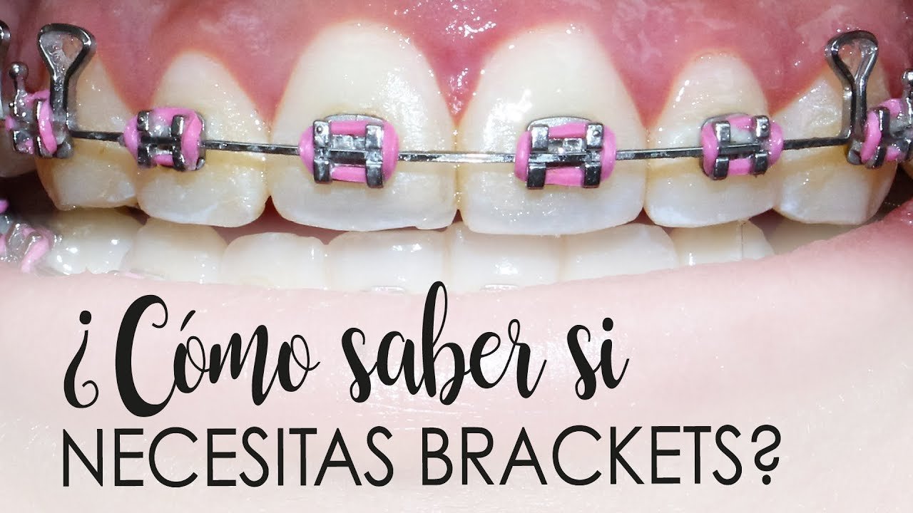 ¿Qué dientes necesitan ortodoncia?