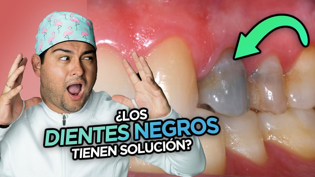 ¿Qué pasa si tengo una carie negra?