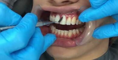 ¿Qué procedimientos estéticos puede hacer un odontologo?