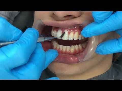 ¿Qué procedimientos estéticos puede hacer un odontologo?