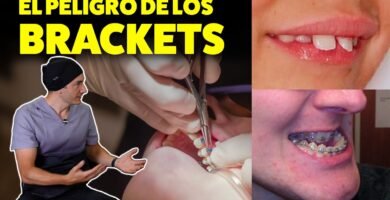 ¿Qué riesgos tiene ponerse brackets?
