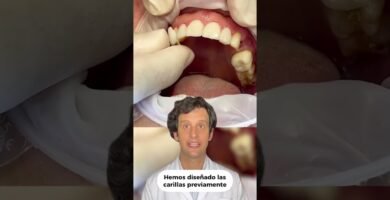¿Cómo mejorar tu sonrisa con carillas dentales estéticas?