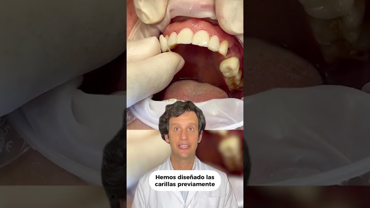 ¿Cómo mejorar tu sonrisa con carillas dentales estéticas?