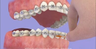 Cómo los cepillos dentales inalámbricos combaten la caries dental en brackets