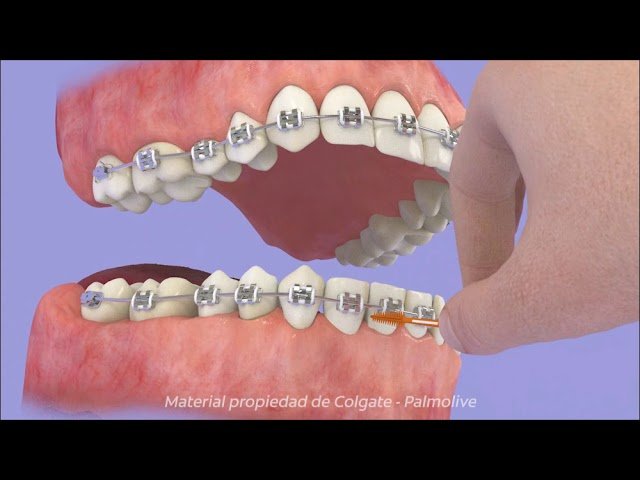 Cómo los cepillos dentales inalámbricos combaten la caries dental en brackets