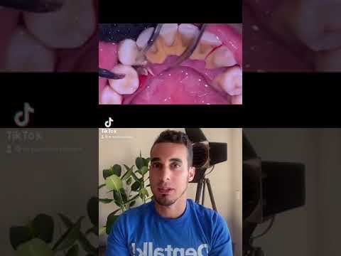 Consejos prácticos para una limpieza dental ideal con cepillos inalámbricos