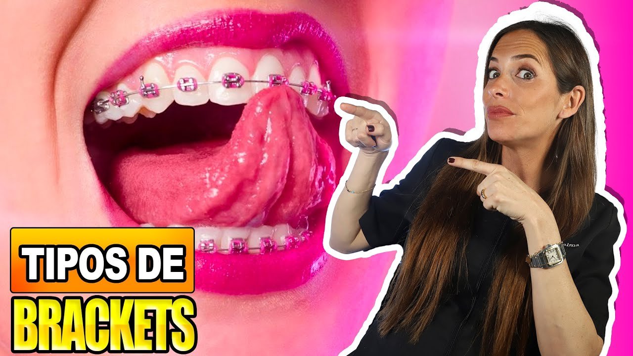 Diferencias entre brackets de zafiro y metálicos