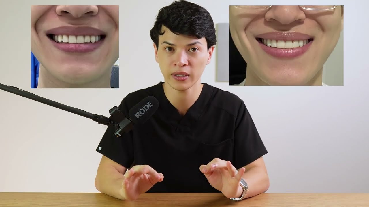 Diferencias entre carillas de resina y de porcelana