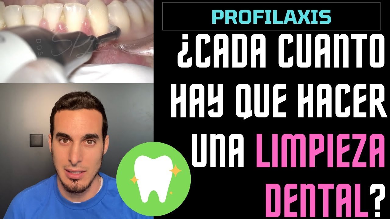 Limpieza dental profunda: ¿cada cuánto tiempo es recomendable?