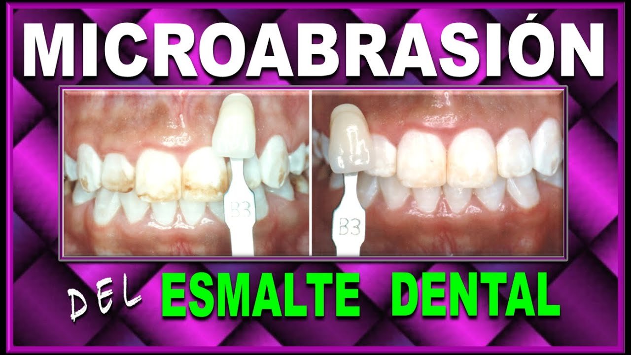Microabrasión dental: qué es y cuándo se recomienda