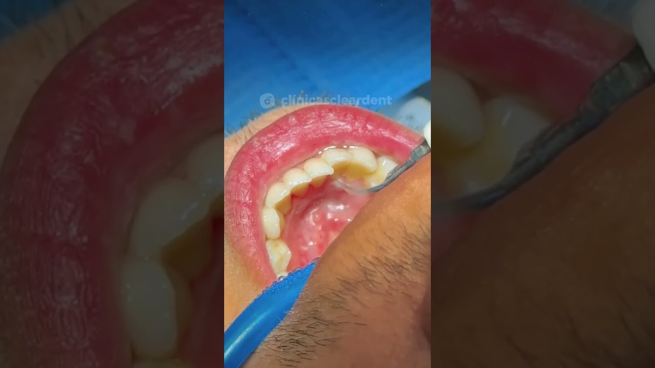 Técnicas avanzadas de limpieza dental con cepillo inalámbrico Guía paso a paso