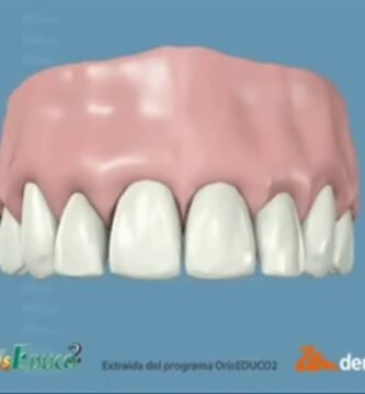 ¿Qué es el contorneado estético dental?