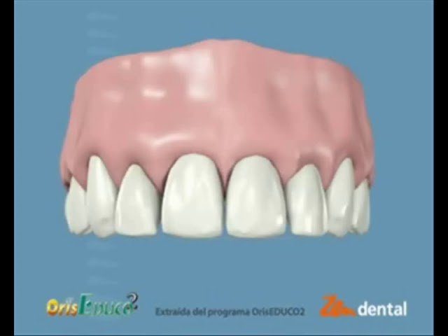 ¿Qué es el contorneado estético dental?