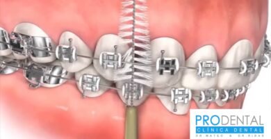 Cómo cepillarse correctamente los dientes con brackets