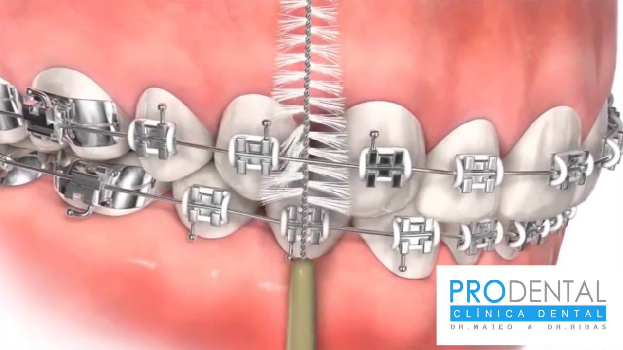 Cómo cepillarse correctamente los dientes con brackets