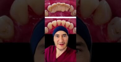 Limpieza de dientes y prevención de sarro con cepillo inalámbrico Guía paso a paso