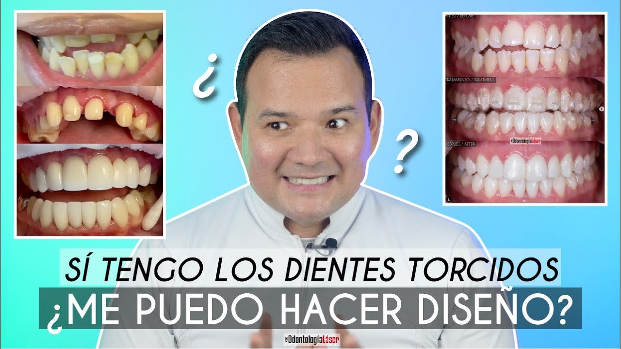 Técnicas modernas para corregir dientes torcidos sin ortodoncia