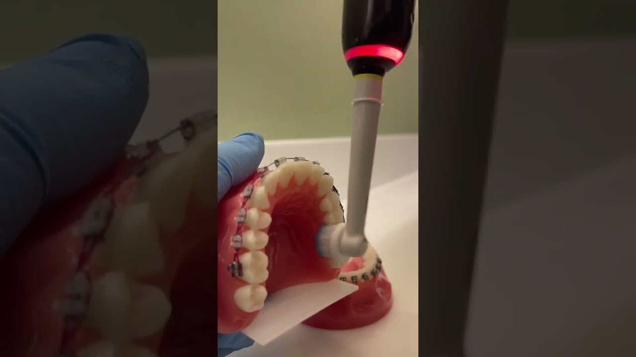 Cepillos dentales inalámbricos para personas con brackets: curiosidades Secretos revelados