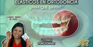 Cómo funcionan los elásticos en un tratamiento de ortodoncia