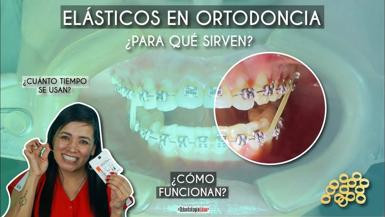 Cómo funcionan los elásticos en un tratamiento de ortodoncia