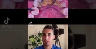 ¿Cepillos dentales inalámbricos eliminan mejor el sarro dental? Guía paso a paso