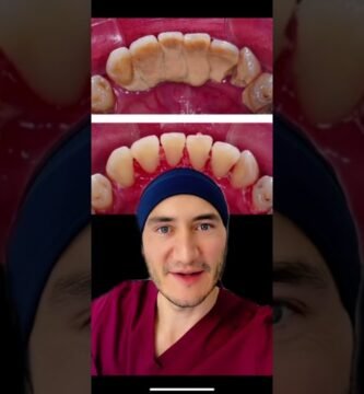 Errores comunes en la limpieza de dientes con cepillos inalámbricos Lo que debes saber