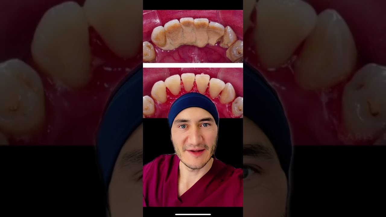 Errores comunes en la limpieza de dientes con cepillos inalámbricos Lo que debes saber