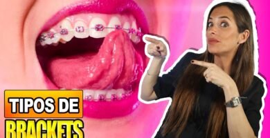 Ortodoncia para adolescentes: ¿cuál es la mejor opción?