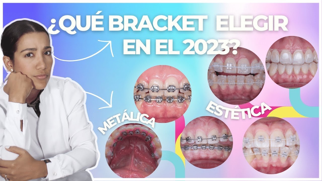 Brackets linguales: ventajas y desventajas