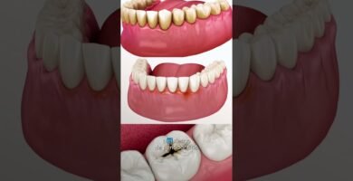 ¿Los cepillos dentales inalámbricos eliminan bacterias que causan caries? Guía completa
