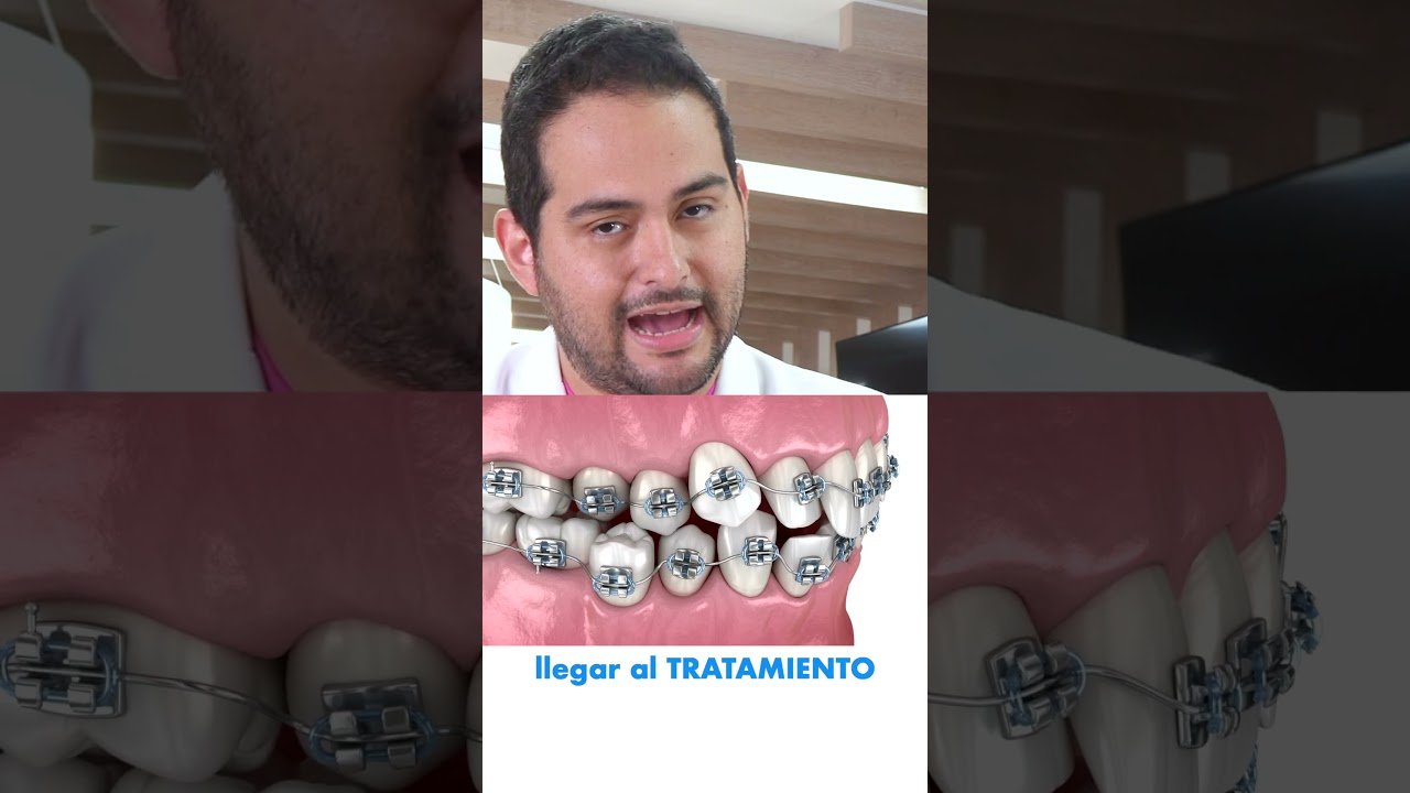 Duración promedio de un tratamiento de ortodoncia con brackets
